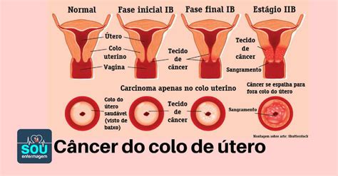 cancer colo do utero-4